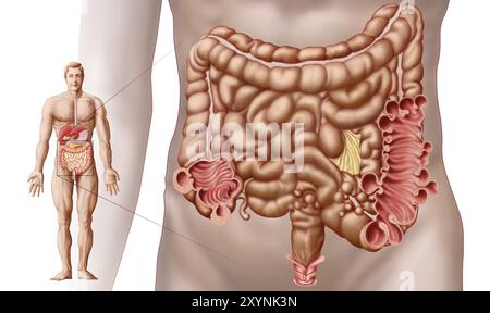 Illustration d'une diverticulite dans la région colique descendante de l'intestin humain. La diverticulite est une maladie digestive fréquente des intestins Banque D'Images