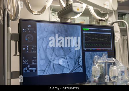 Istanbul, Turquie 29 février 2024 ; radiographie pour remplacement valvulaire avec valve mélodique. Vue d'une dysfonction valvulaire prothétique chez un patient atteint de mi Banque D'Images