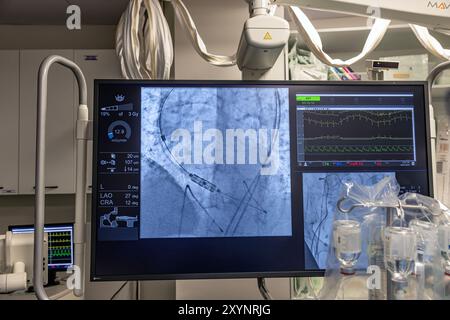 Istanbul, Turquie 29 février 2024 ; radiographie pour remplacement valvulaire avec valve mélodique. Vue d'une dysfonction valvulaire prothétique chez un patient atteint de mi Banque D'Images