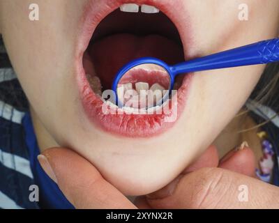 Petite fille à l'examen d'un dentiste perdre dent avec un miroir dentaire Banque D'Images