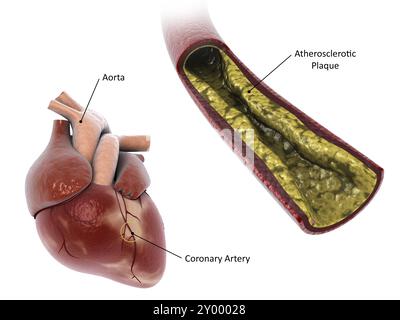 Illustration médicale d'une plaque d'athérosclérose dans l'artère, conduisant à une crise cardiaque Banque D'Images