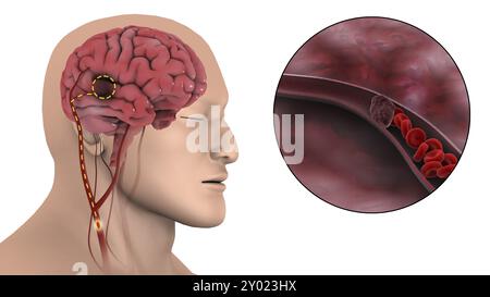 Illustration médicale d'un accident vasculaire cérébral ischémique, où l'apport sanguin à une partie du cerveau est diminué Banque D'Images