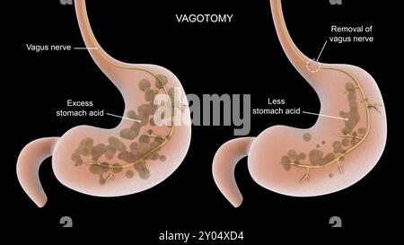 Illustration médicale d'une intervention chirurgicale de vagotomie pour enlever une partie du nerf vague Banque D'Images