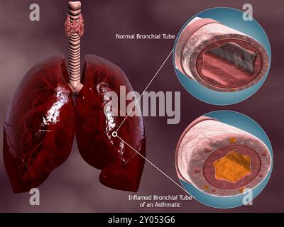 Section transversale trachéale avec poumons, comparant bronchiole normale et asthmatique Banque D'Images