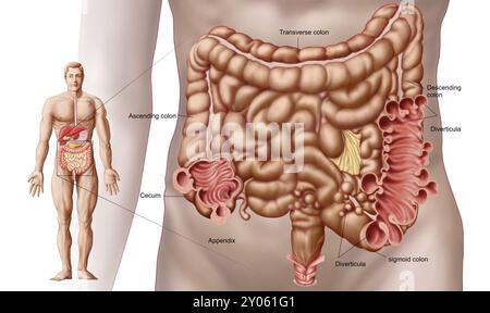 Illustration d'une diverticulite dans la région colique descendante de l'intestin humain. La diverticulite est une maladie digestive fréquente des intestins Banque D'Images