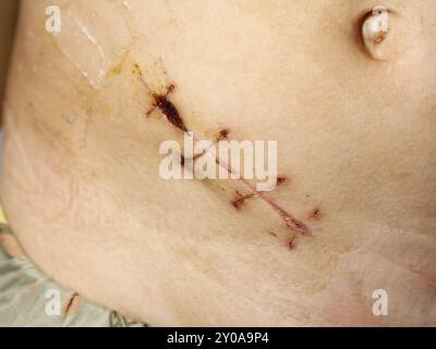 Annexe retrait médicament aide à la suture chirurgicale cicatrice Banque D'Images