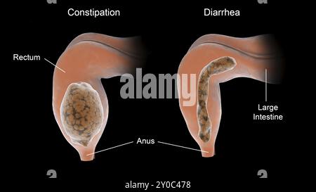 Diagramme comparatif de la constipation vs diarrhée dans le corps humain Banque D'Images