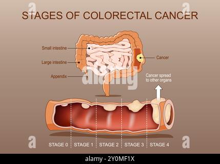 Stades du cancer colorectal. Section transversale du gros intestin avec tumeur. Gros plan sur une tumeur maligne du côlon. Affiche vectorielle détaillée. Isometri Illustration de Vecteur