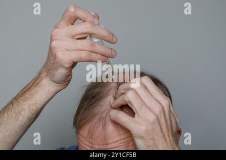 Homme souffrant de perte de cheveux en utilisant le sérum de cheveux ou minoxidil pour traiter l'alopécie et la perte de cheveux Banque D'Images