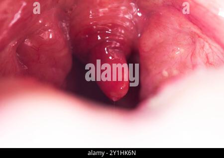 Uvulite et mal de gorge dans la cavité buccale dus à la maladie. Inflammation de la luette et des amygdales due à des infections pendant la maladie, gros plan Banque D'Images