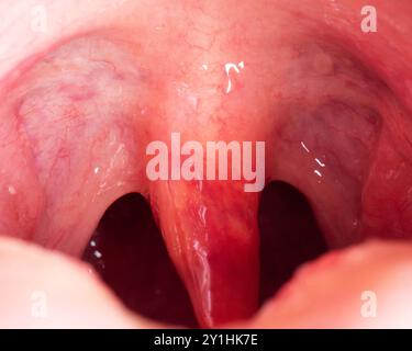 Luette rouge, enflammée et gonflée dans la gorge. Traitement des uvulites à bactéries et à virus streptococciques. Oto-rhino-laryngologie Banque D'Images