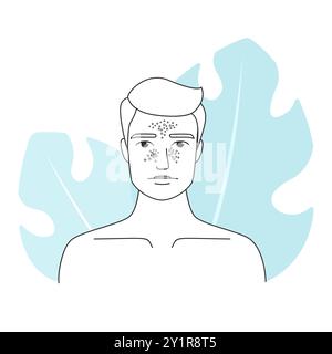 Illustration au trait d'un homme atteint de mélasme et d'hyperpigmentation. Concept de vecteur de problème de soin de la peau. Illustration de Vecteur