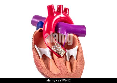 Modèle cardiaque d'implantation valvulaire aortique transcathéter (TAVI) pour l'éducation. Transplantation cardiaque et concept de chirurgie, shunting. Homme plastique HE Banque D'Images