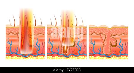 Épilation au laser. Profondeur de pénétration par divers lasers. Illustration de Vecteur