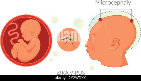 Risque lié au virus Zika pendant la grossesse - illustration sous forme de fichier EPS 10 Illustration de Vecteur