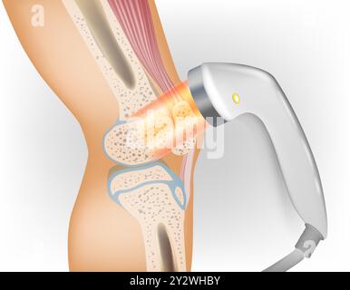 Science de thérapie laser médicale. Thérapie laser sur un genou. Illustration de Vecteur