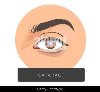 Œil humain avec cataracte - illustration stock en tant que fichier EPS 10 Illustration de Vecteur