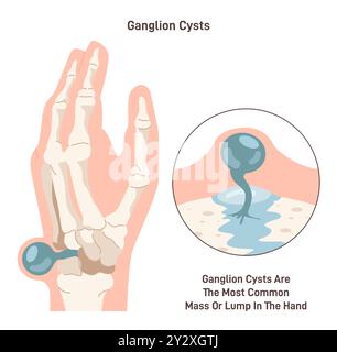 Kyste ganglionnaire. Masse remplie de liquide sous la peau d'un poignet ou d'une main. Kyste synovial sur une articulation ou dans un tendon. Illustration vectorielle plate Illustration de Vecteur