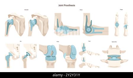 Ensemble d'implantation articulaire. Articulation humaine blessée ou distraite remplacée par une prothèse artificielle en titane. Chirurgie du traitement de l'ostéoporose et de l'arthrose. Illustration vectorielle plate Illustration de Vecteur