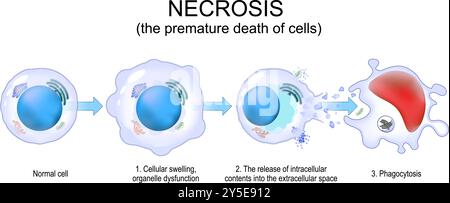 Nécrose. Mort cellulaire prématurée incontrôlée. Rupture de membrane cellulaire et fragmentation cellulaire. Phagocytose. Vecteur. Schéma de principe. Affiche détaillée. Illustration de Vecteur