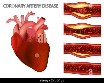 Coronaropathie et cardiopathie ischémique. Athérosclérose dans une artère coronaire. Maladies cardiovasculaires. Réduction du flux sanguin vers la carte Illustration de Vecteur