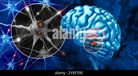 Substantia Nigra et la maladie de Parkinson comme un trouble neurologique progressif affectant le mouvement et la coordination du corps comme les cellules neuronales perdant functi Banque D'Images