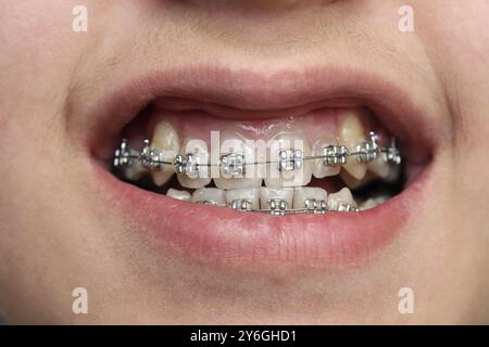 Vue rapprochée sur les dents d'enfants avec des appareils orthodontiques Banque D'Images