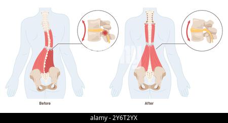 Effet massage. Traitement des douleurs dorsales et relaxation musculaire. Muscle spasmé d'une colonne vertébrale et rééducation physique du nerf pincé. Illustration vectorielle plate Illustration de Vecteur