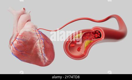 Illustration de la maladie coronarienne. Il montre le rétrécissement ou le blocage des artères coronaires dû à l'accumulation de plaques, ce qui réduit le flux sanguin vers le muscle cardiaque, conduisant à des dommages cardiaques potentiels. Banque D'Images