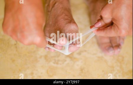 Traitement de l'hallux valgus. La femme applique une attelle de valgus, un espaceur de doigt en silicone. Photo de haute qualité Banque D'Images