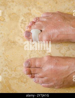 Traitement et prévention de l'hallux valgus. Séparateur de doigts en silicone. Photo de haute qualité Banque D'Images