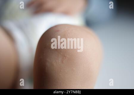 Eczéma dermatite atopique infectieuse cutanée. Banque D'Images