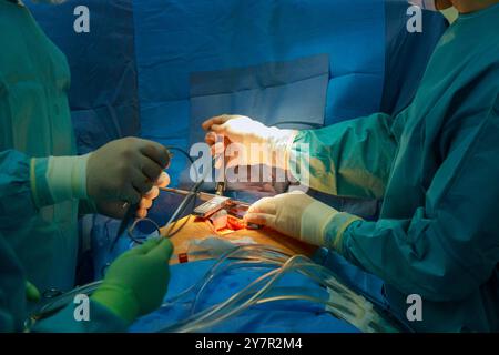 Une salle d'opération à l'hôpital est occupée par une équipe médicale de chirurgiens effectuant une chirurgie à cœur ouvert sur le patient Banque D'Images