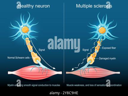 Sclérose en plaques. Myéline assurant une conduction lisse du signal aux muscles dans un neurone sain. Neurone de sclérose en plaques avec myéline endommagée, exposé Illustration de Vecteur