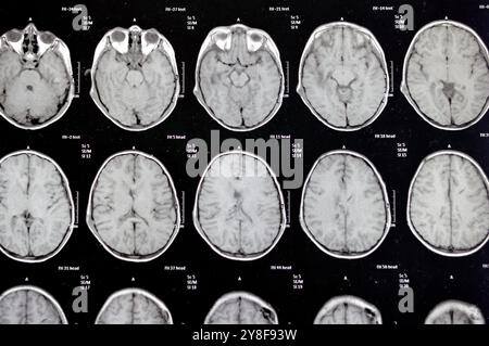 L'IRM du cerveau révèle des opérations de shunt antérieures pour un cas d'hydrocéphalie, une lésion de para-falcine préventriculaire frontale droite rehaussant avec suspecte Banque D'Images