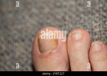 Maladie fongique de l'ongle de pied de la femme. Banque D'Images