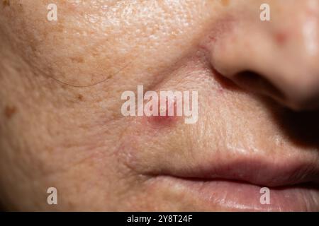 Gros plan d'un bouton sur le visage d'une femme. Bouton sur le visage. Boutons et acné sur la peau du visage, zoom macro. Peau poreuse huileuse. Banque D'Images