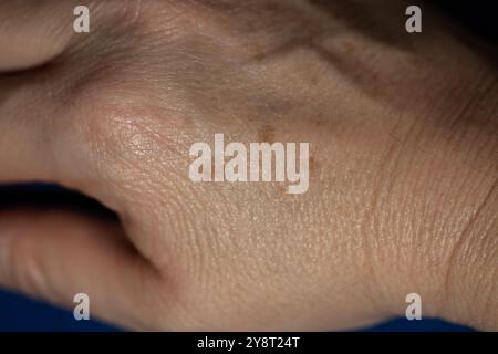 Taches brunes sur les mains d'une femme d'âge moyen. Çiller, problèmes de peau sur les mains des femmes turques. Banque D'Images