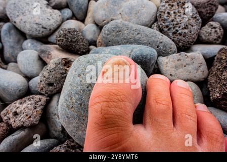 clou du gros orteil droit noirci par un écrasement et par les chaussures serrées d'un chemin de pied d'un homme adulte avec fond de pierres volcaniques Banque D'Images