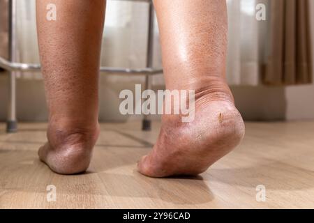 La jambe de la femme est oedème (gonflement) après le traitement du cancer. Banque D'Images