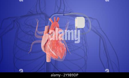 stimulateur cardiaque dans une veine implantée dans le coeur humain Banque D'Images