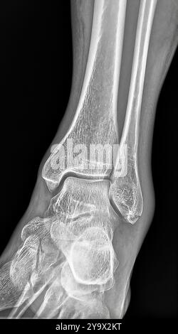 Radiographie de la cheville montrant une fracture de la malléole latérale sans luxation, soulignant l'importance de l'imagerie médicale dans le diagnostic et Banque D'Images