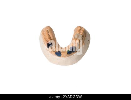 Prothèse partielle montée sur un modèle d'étude en plâtre et placée sur un fond blanc Banque D'Images