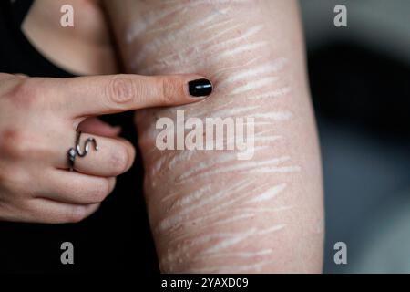 Nuremberg, Allemagne. 10 octobre 2024. Une victime de comportement auto-mutilant montre des cicatrices sur son bras. Ils témoignent tous de coupures profondes avec des lames de rasoir que la jeune femme de 31 ans s'est infligée. La jeune femme de Nuremberg souffre d'un trouble de la personnalité limite - une maladie mentale dans laquelle les personnes touchées souffrent de fortes sautes émotionnelles et d'humeur. Beaucoup souffrent de l'automutilation afin de réduire leur tension intérieure. Crédit : Daniel Karmann/dpa/Alamy Live News Banque D'Images