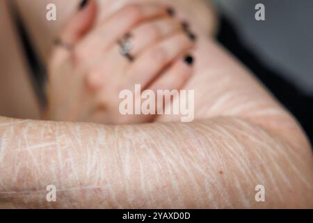 Nuremberg, Allemagne. 10 octobre 2024. Une victime de comportement auto-mutilant montre des cicatrices sur son bras. Ils témoignent tous de coupures profondes avec des lames de rasoir que la jeune femme de 31 ans s'est infligée. La jeune femme de Nuremberg souffre d'un trouble de la personnalité limite - une maladie mentale dans laquelle les personnes touchées souffrent de fortes sautes émotionnelles et d'humeur. Beaucoup souffrent de l'automutilation afin de réduire leur tension intérieure. Crédit : Daniel Karmann/dpa/Alamy Live News Banque D'Images