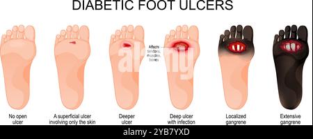 Ulcères du pied diabétique. Classification de la gravité du risque d'ulcération à la gangrène étendue et à la mort tissulaire des jambes. Affiche vectorielle Illustration de Vecteur