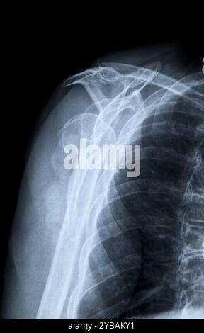 Fracture de l'humérus droit, radiographie axiale après accident Banque D'Images