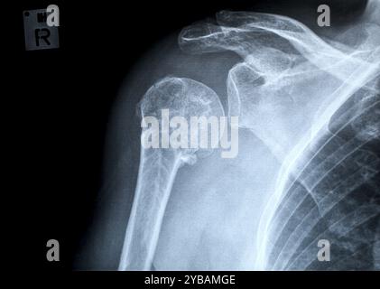 Fracture humérale droite, image antéro-postérieure (ap) à l'aide d'une radiographie conventionnelle, fracture humérale droite, images radiologiques frontales à l'aide d'une radiographie normale Banque D'Images