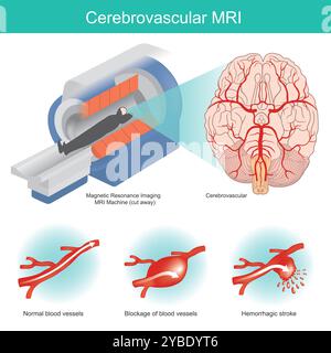 IRM cérébrovasculaire. l'imagerie cérébrale par machine spéciale est utile pour l'évaluation d'un large éventail de maladies cérébrovasculaires. Banque D'Images