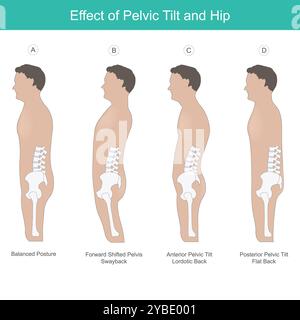 Effet de l'inclinaison pelvienne et de la hanche. Comparaison de l'os du bassin et des hanches dans la bonne position physiologie humaine. Banque D'Images